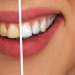 Tooth Difference