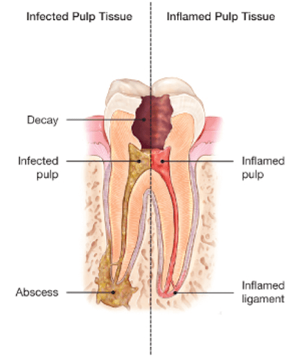 Root Canal Treatment Auckland