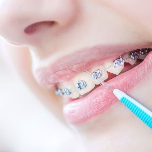 braces | braces cost nz | braces auckland | braces nz