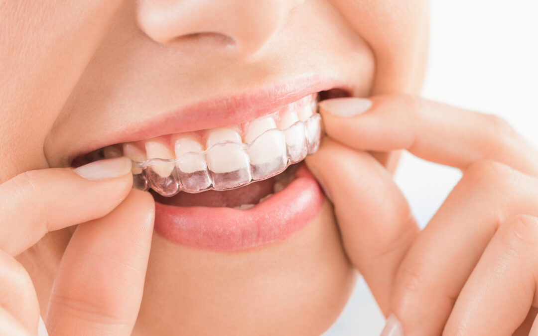 Are You Ready To Get Your Teeth Straightened With Invisalign Auckland?