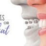 Invisalign Vs Traditional Braces, Straighten Your Teeth With Invisalign - Comfortable And Discreet.